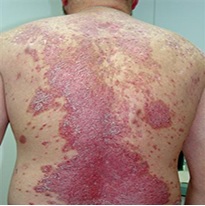  Psoriasis and Skin Diseases